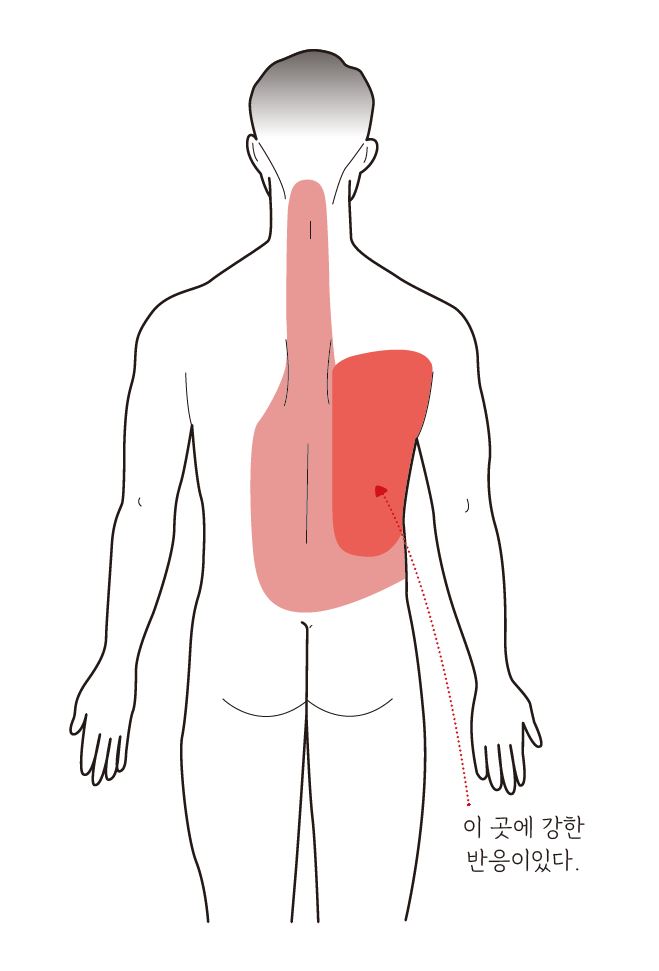 간암