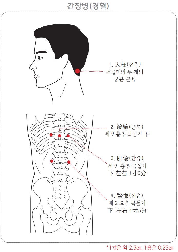 간장병