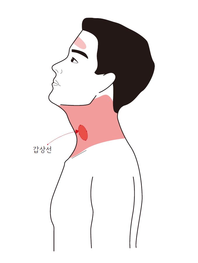 갑상선암