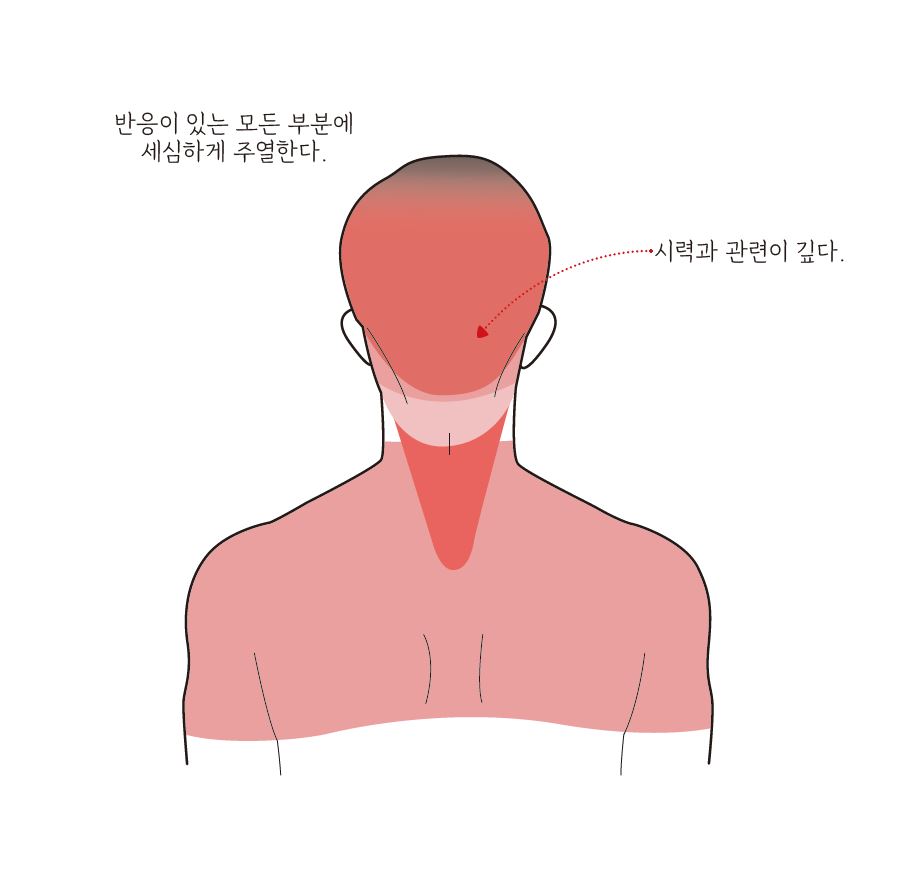 뇌종양
