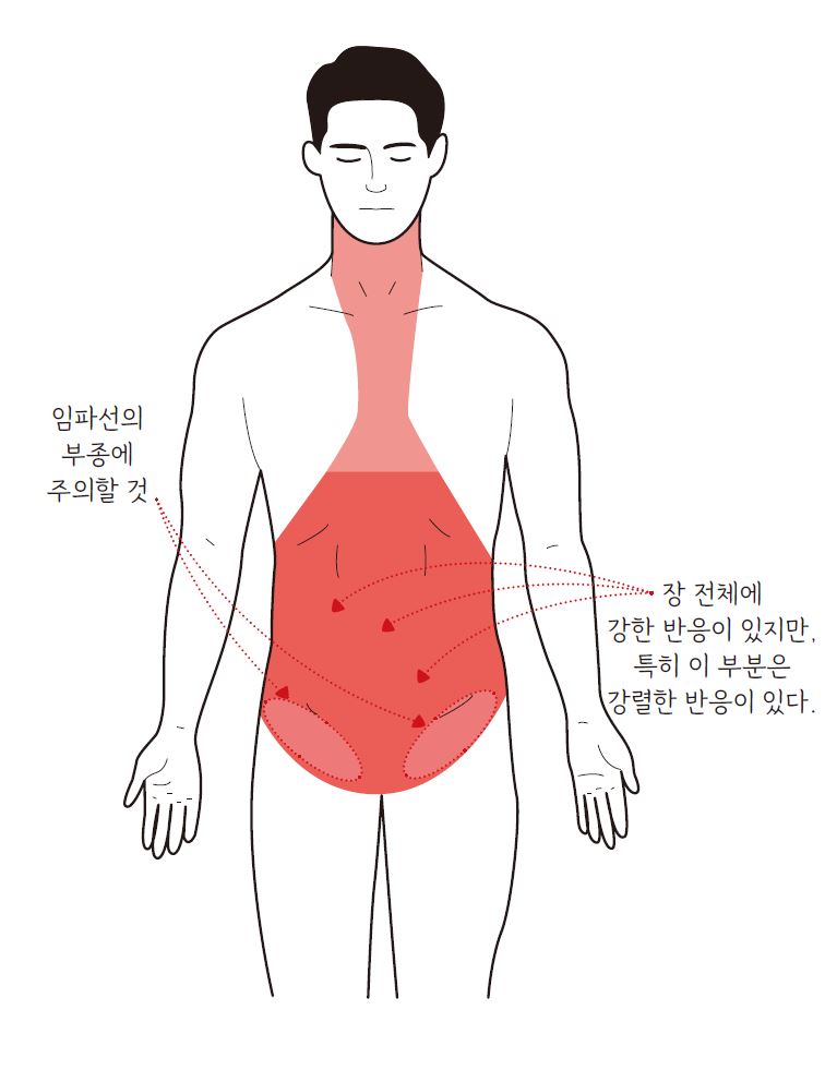 대장암