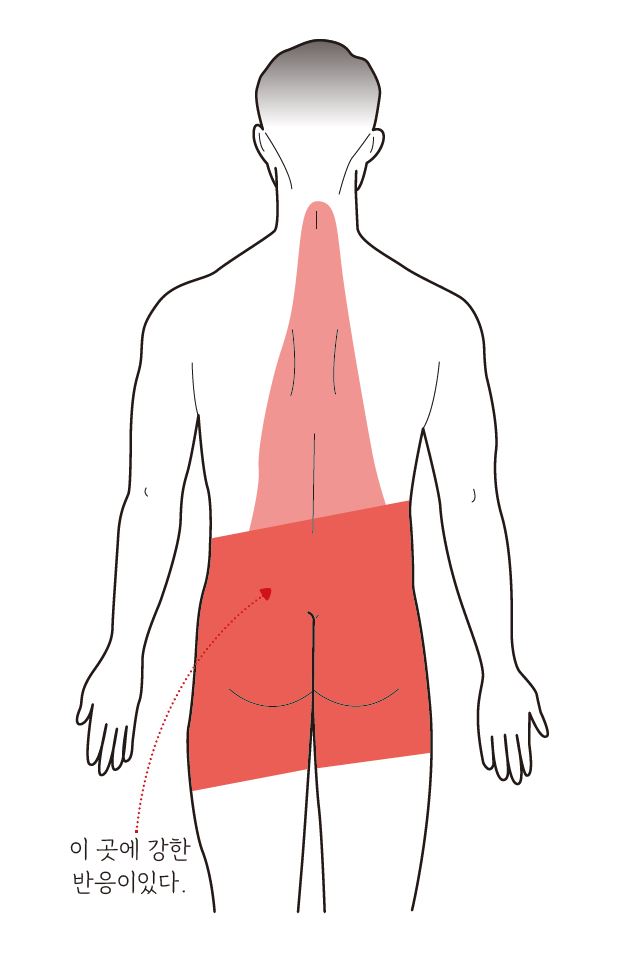대장암