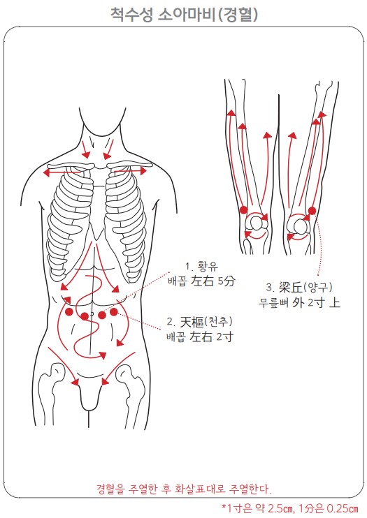 소아마비