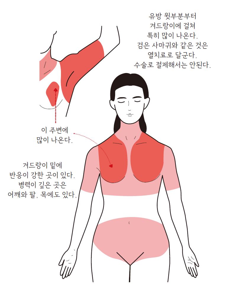 유방암