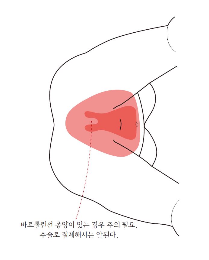 자궁