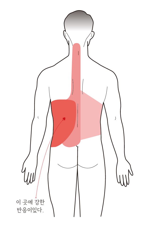 췌장암