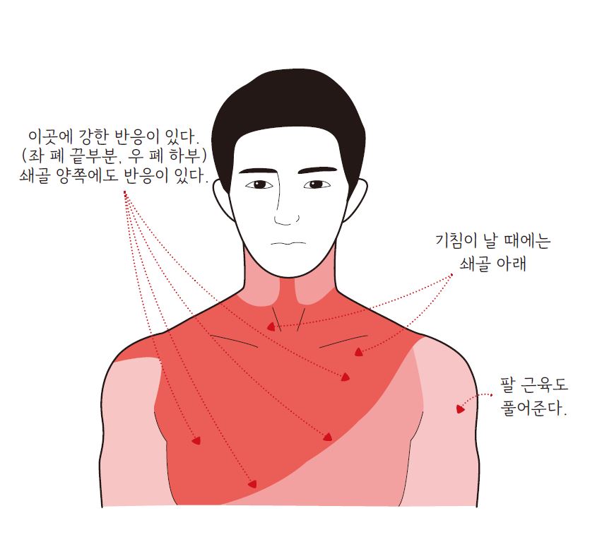 폐암